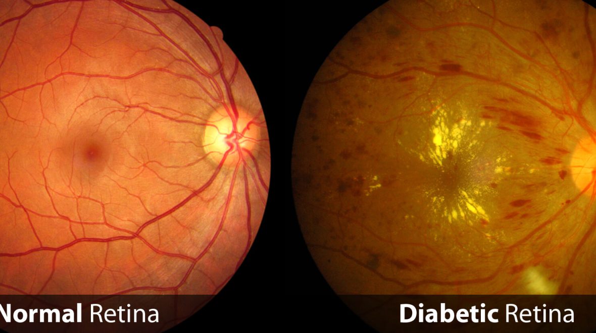 Diabetic Retinopathy